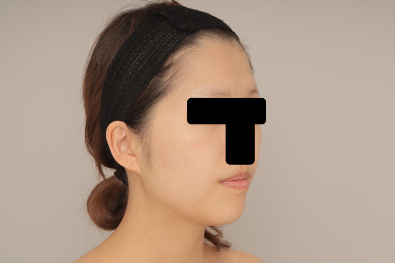 ベイザー脂肪吸引(6か月経過:25)の術前写真