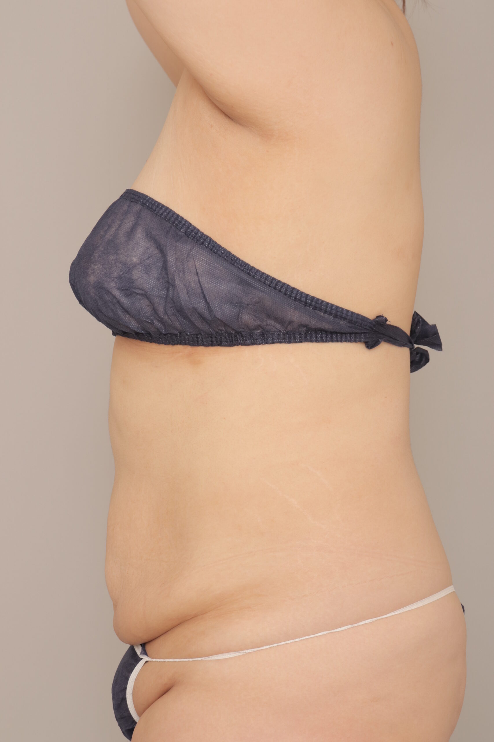 腹部だけで5000ccを吸引した20代女性の4か月経過です。