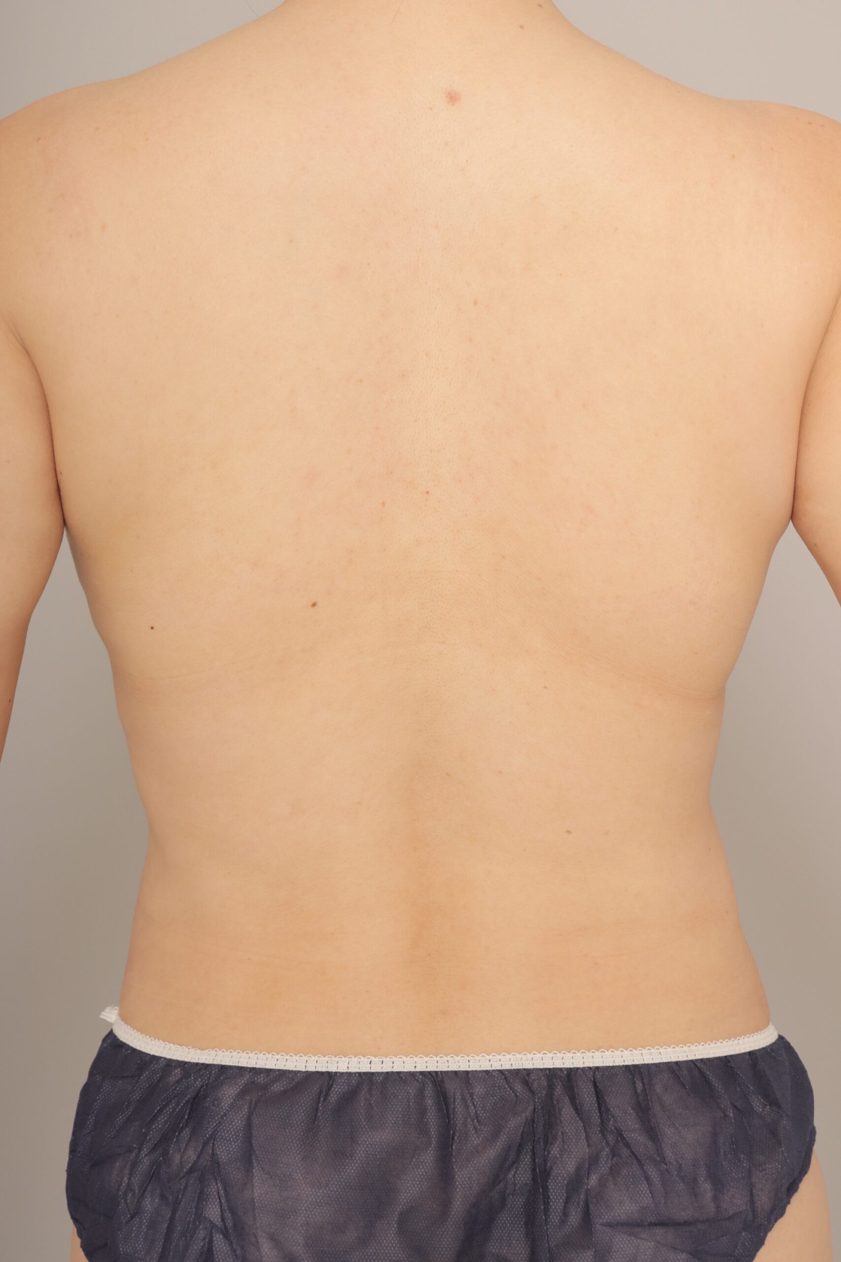 ベイザー脂肪吸引（6か月経過：39）の術前写真