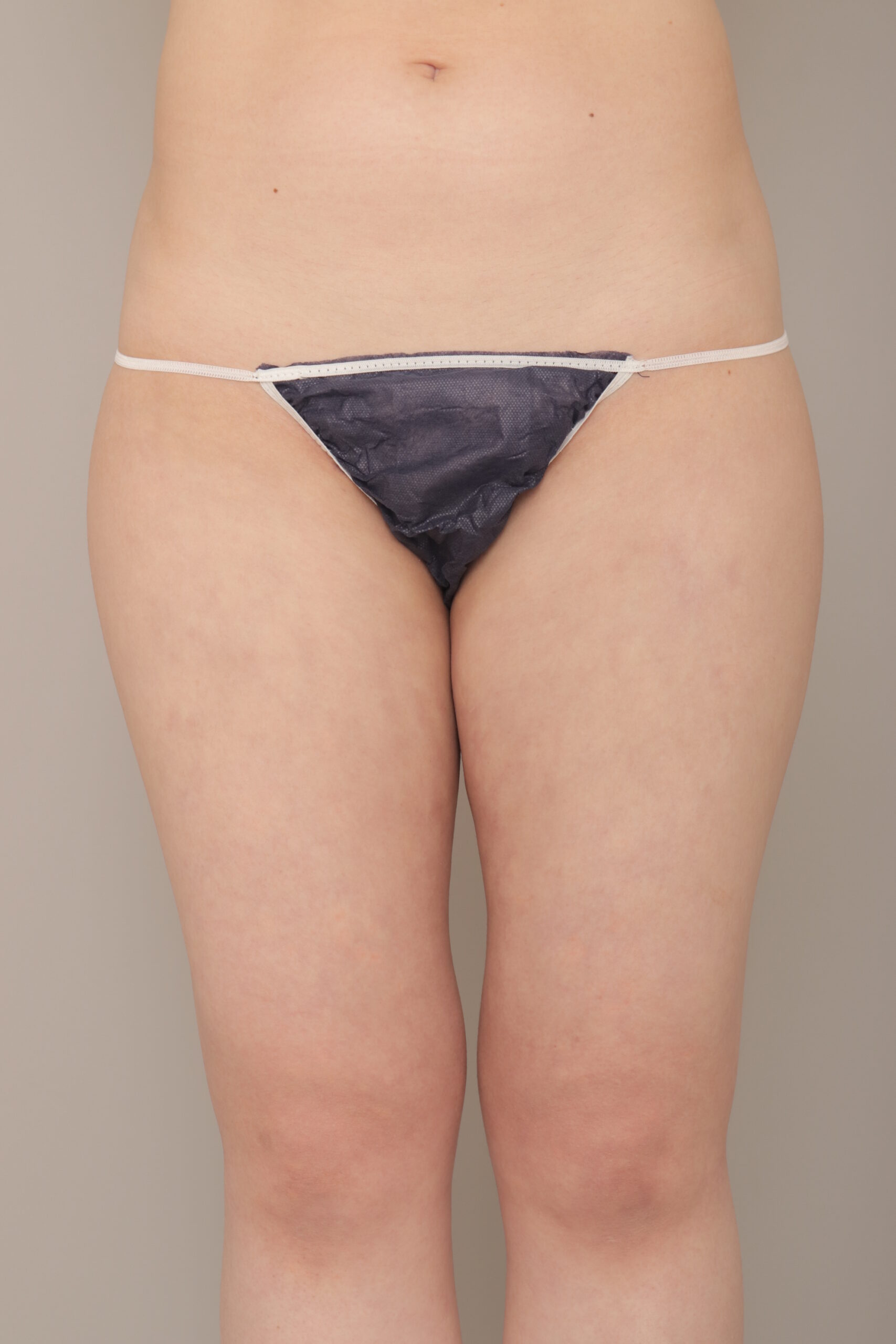 ベイザー脂肪吸引（1ヵ月経過：22）の術後写真