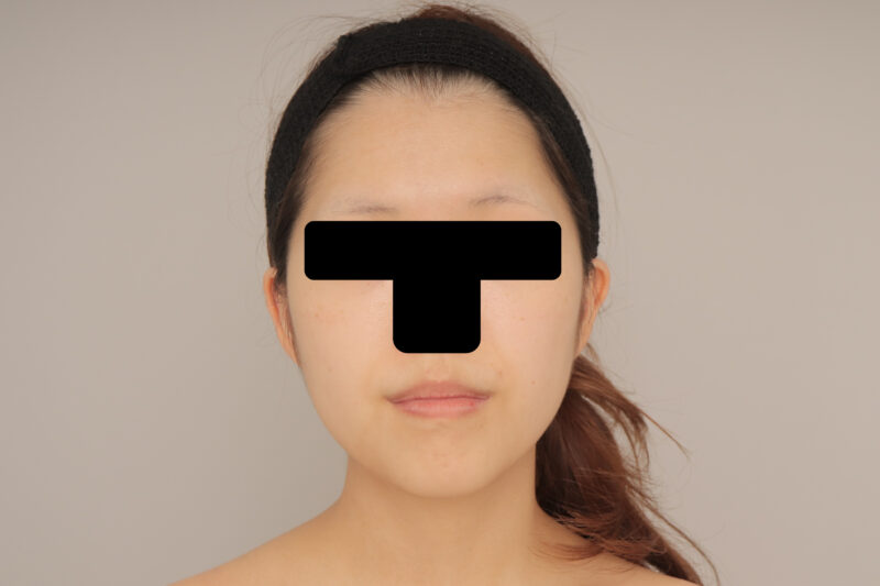 ベイザー脂肪吸引（3か月経過：25）の術前写真