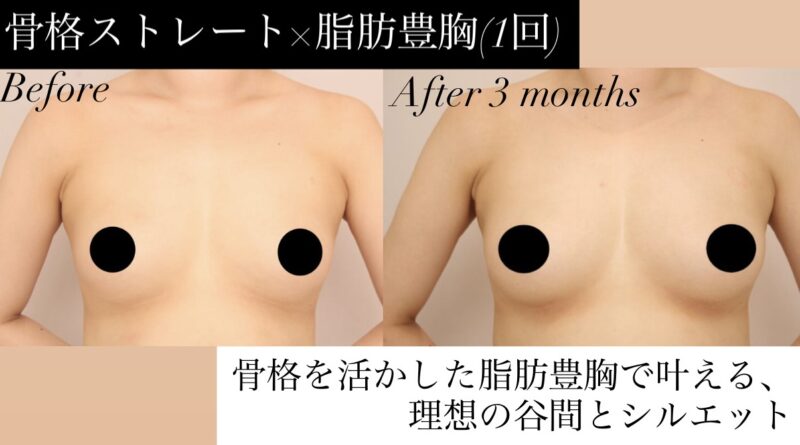 【骨格ストレート×脂肪豊胸（1回）】骨格を活かした効果的な脂肪豊胸で叶える、理想の谷間とシルエット