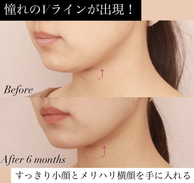 【憧れのVラインが出現！】すっきり小顔とメリハリ横顔を手に入れる