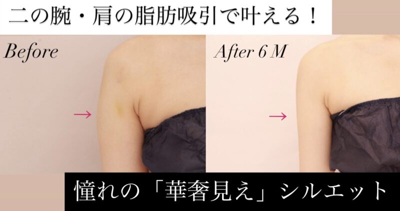 二の腕・肩の脂肪吸引で叶える！直線的で美しい「直角肩」へ