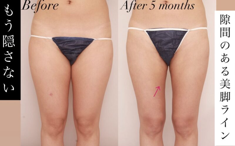 【もう隠さない!】太もも・臀部の脂肪吸引で手に入れた、隙間のある理想の美脚ライン