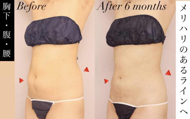 胸下・お腹・腰のボリュームダウン！メリハリのあるボディラインへ