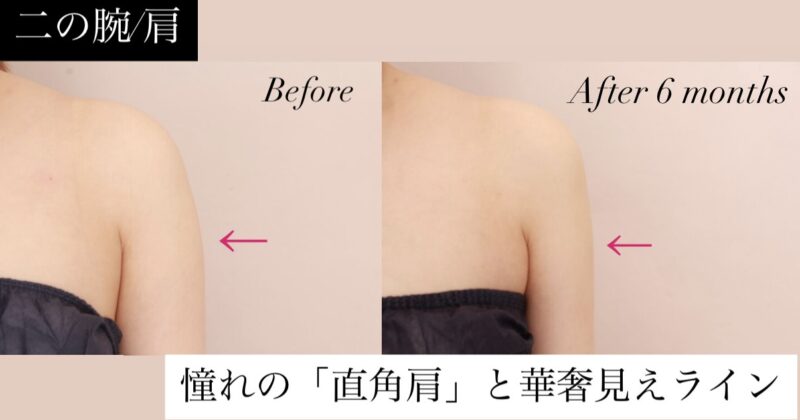 丸い肩とおさらば！脂肪吸引で叶える、憧れの『直角肩』と華奢見えライン