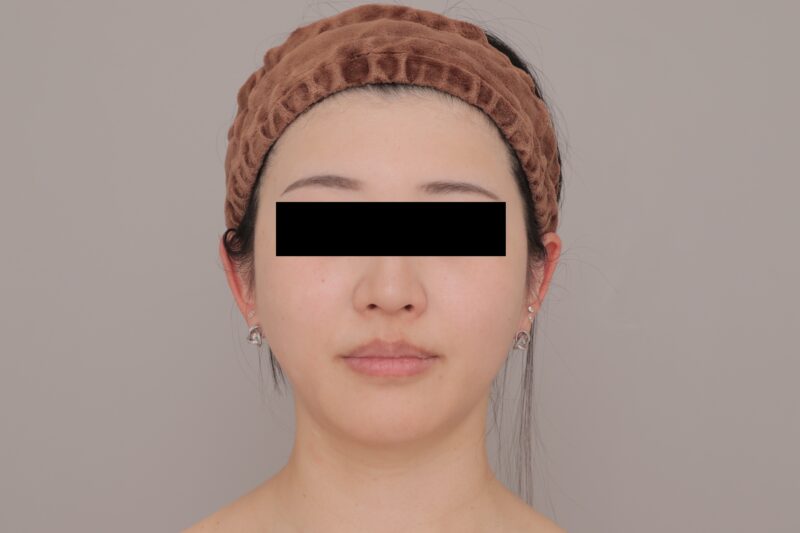 ベイザー脂肪吸引(3ヶ月経過:29)の術後写真