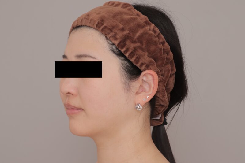 脂肪吸引のおかげでコンテスト1位!?頬顎下脂肪吸引●