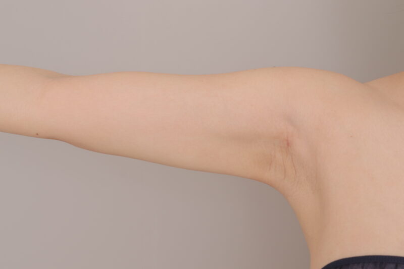 40代の全身脂肪吸引!腕編●