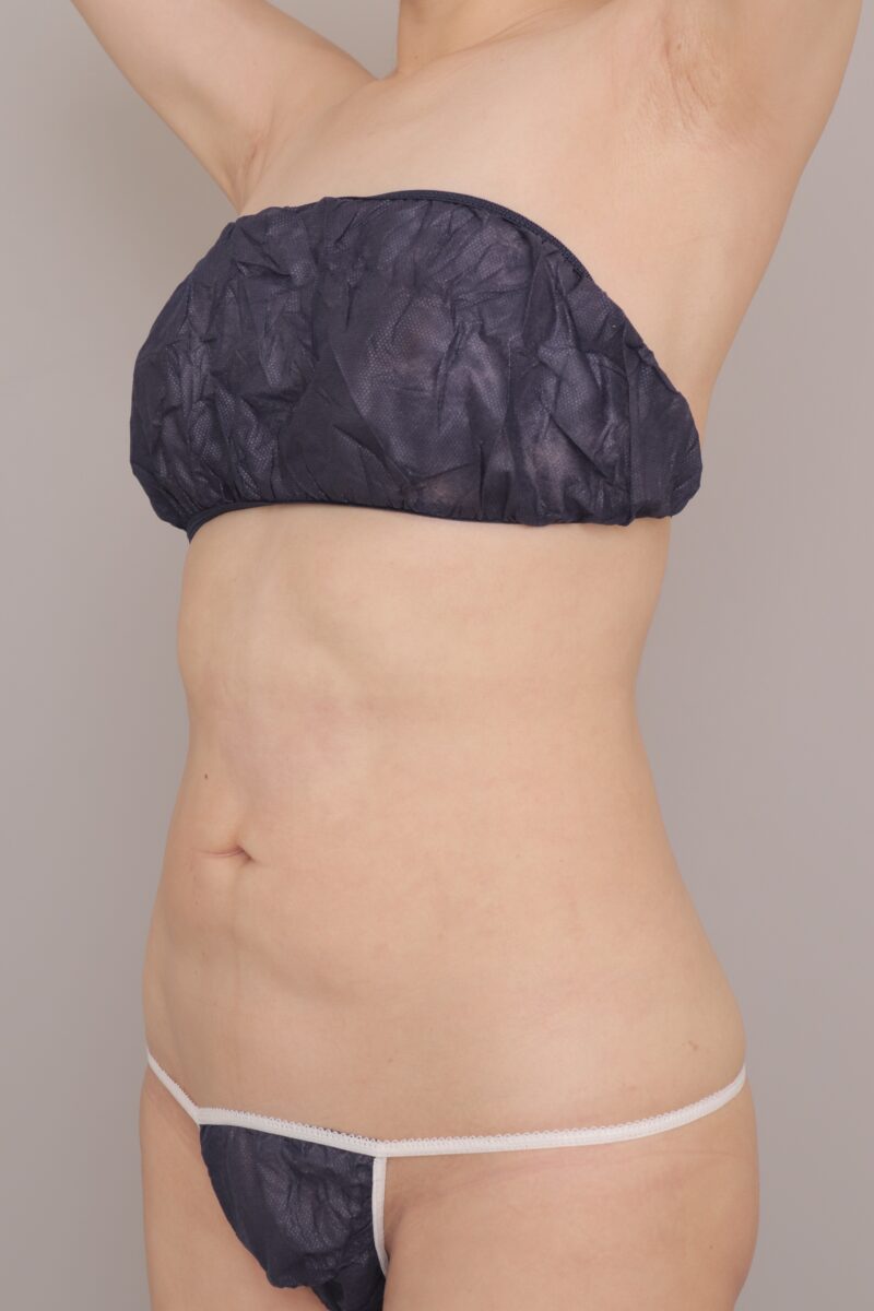 ベイザー脂肪吸引（3ヶ月経過：40）の術後写真