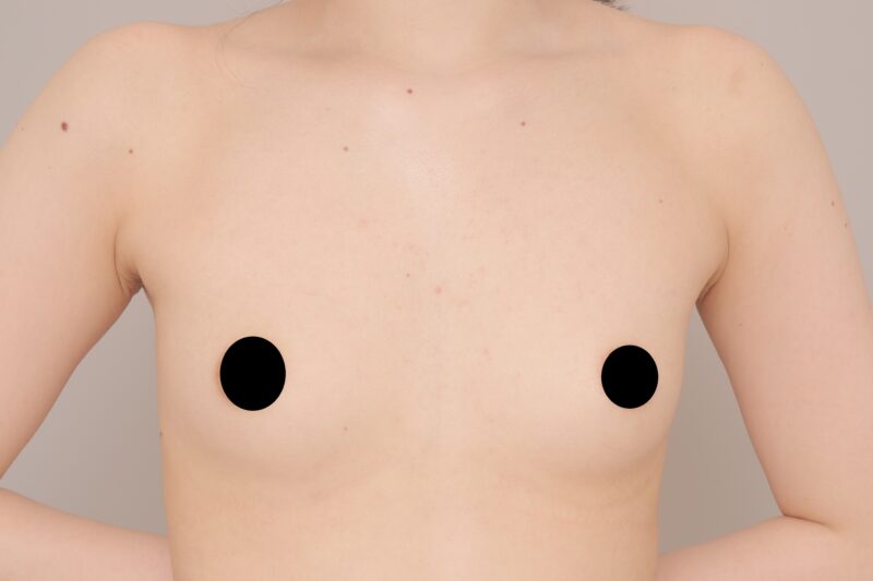 ベイザー脂肪吸引（３か月後経過：21）の術前写真