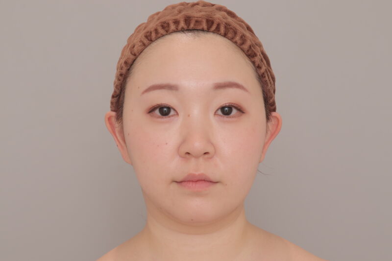 ベイザー脂肪吸引(3ヶ月経過:35)の術後写真