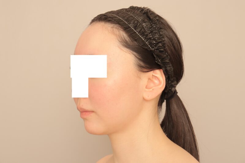 ベイザー脂肪吸引(3ヶ月経過:28)の術後写真