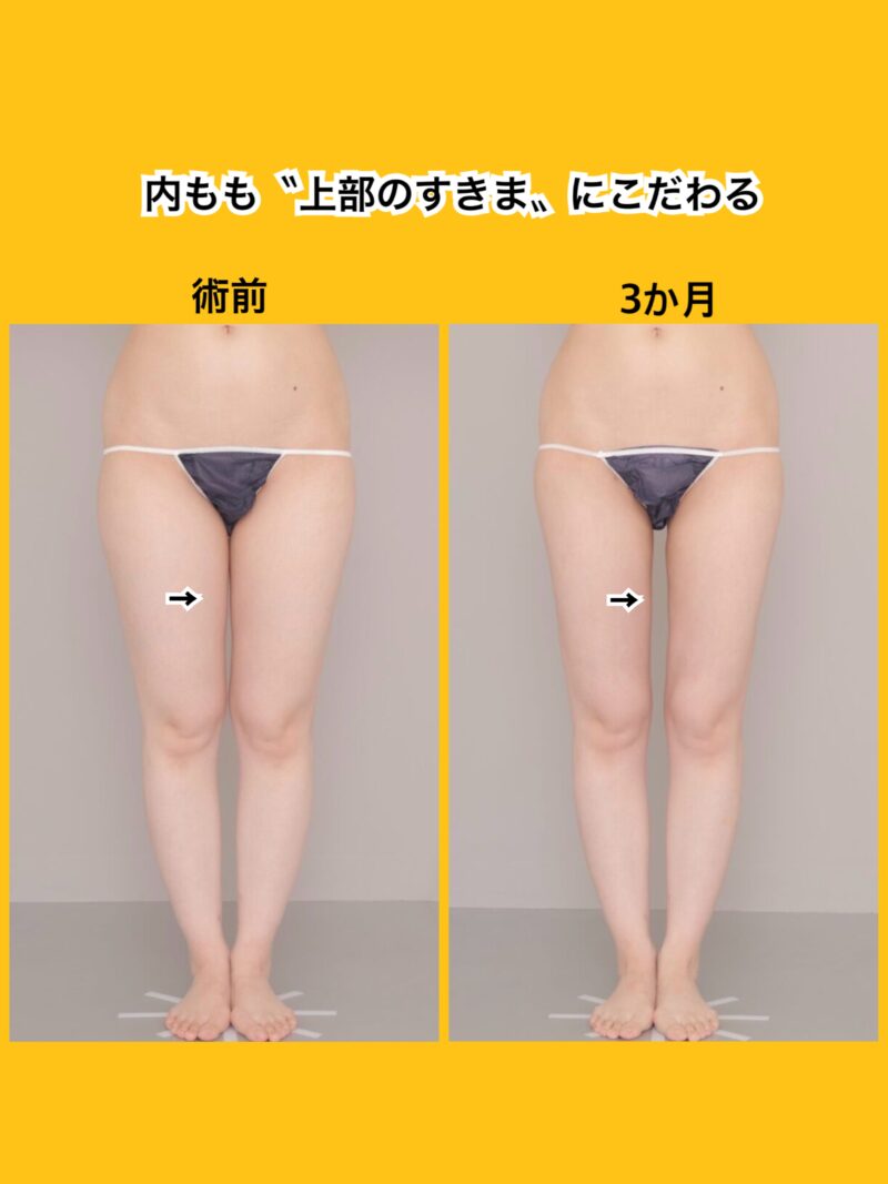 〝すきま〟にこだわる~26歳158cm54kg太もも2800cc吸引後3か月~