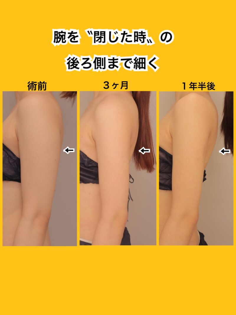 腕の〝後ろ側〟まで細くできます。細い!は続きます~25歳156cm48kg上腕肩脇肉700cc吸引後3ヶ月~