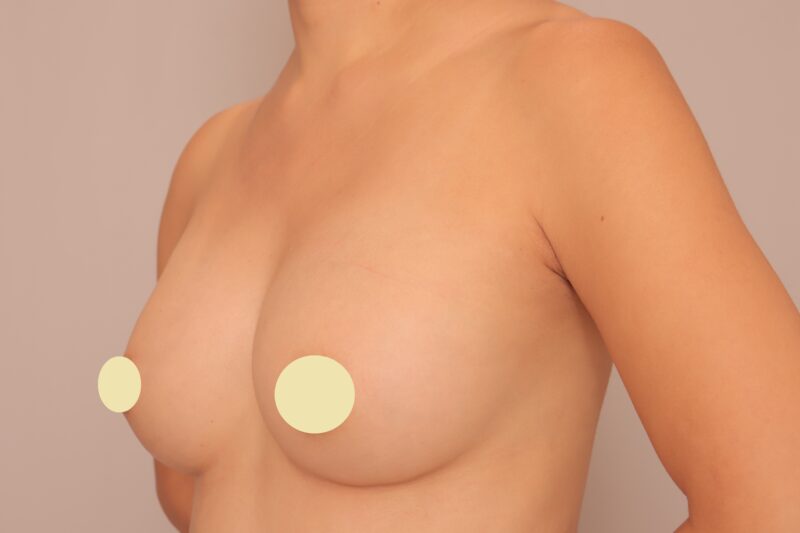 ベイザー脂肪吸引(1ヶ月経過:32)の術後写真