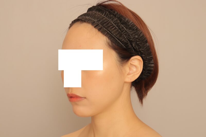 ベイザー脂肪吸引(半年経過:36)の術後写真