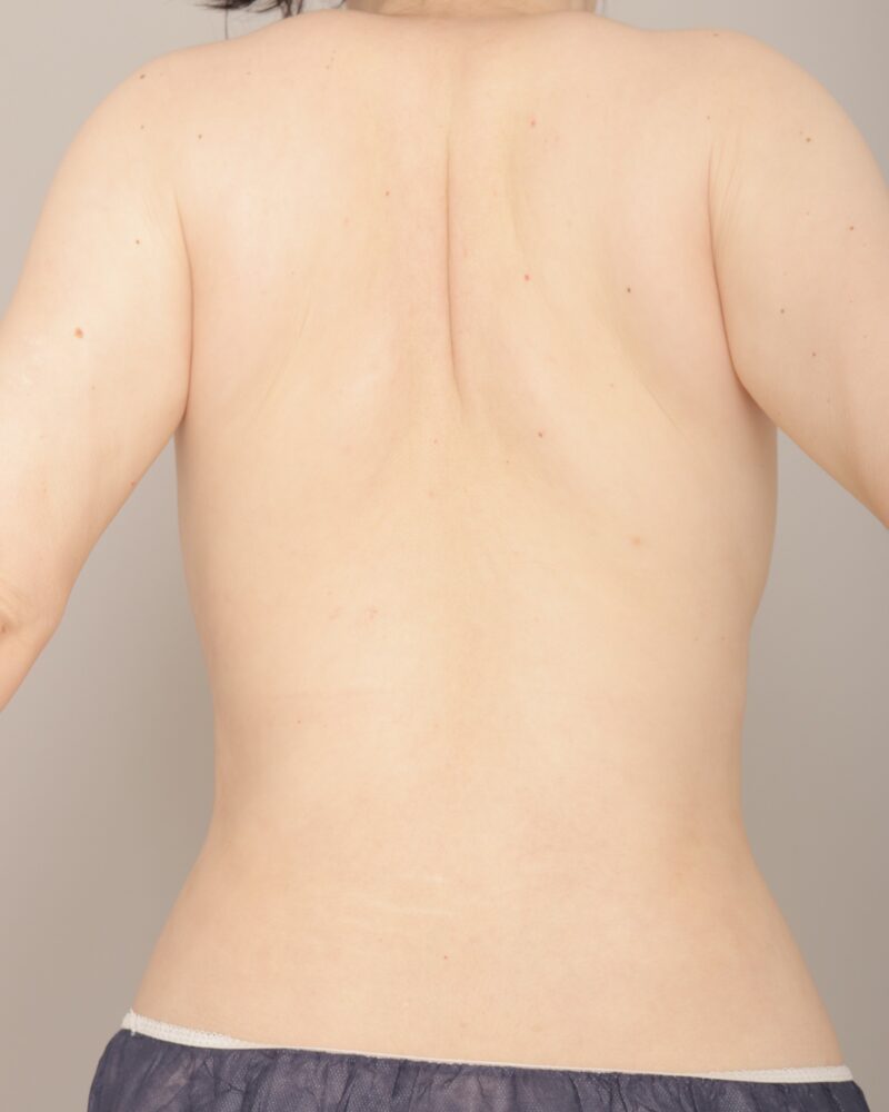 ベイザー脂肪吸引（１か月経過：38）の術前写真