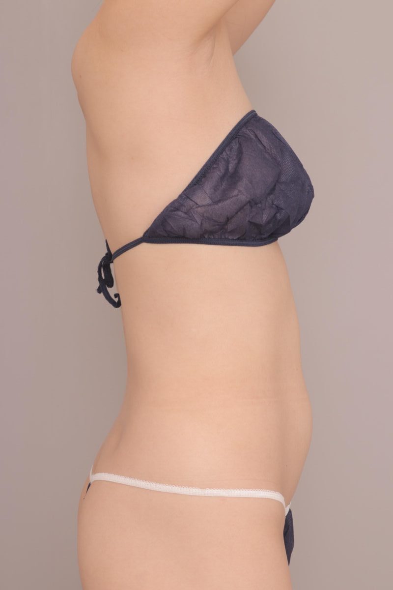 ベイザー脂肪吸引（３ヶ月経過：43）の術前写真