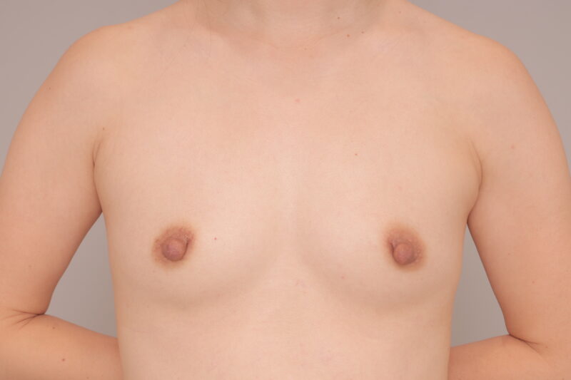 ベイザー脂肪吸引(3ヶ月経過:43)の術前写真