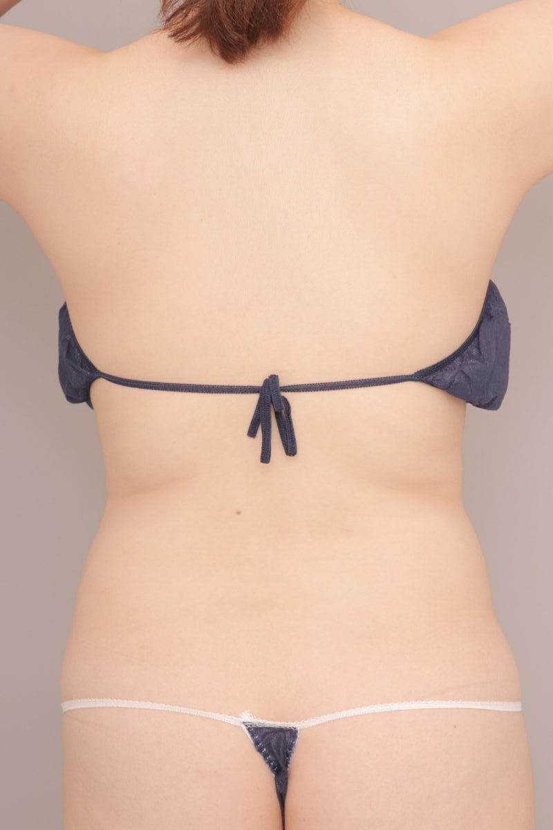 ベイザー脂肪吸引（半年経過：26）の術前写真