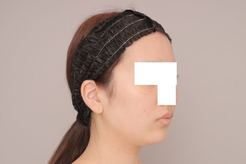 ベイザー脂肪吸引(半年経過:19)の術前写真