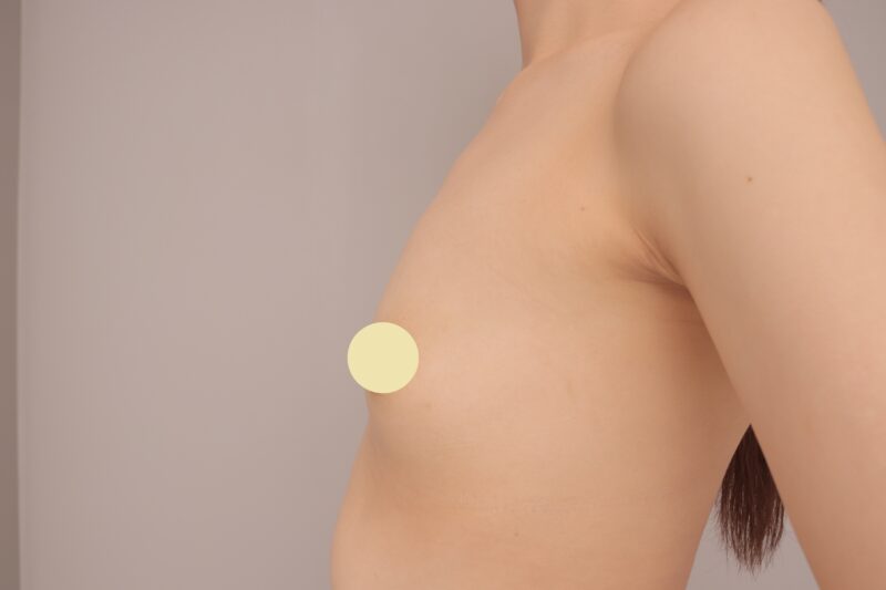 ベイザー脂肪吸引(1ヶ月経過:26)の術前写真