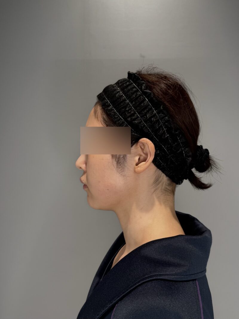 ベイザー脂肪吸引(術後6ヶ月経過:26)の術前写真