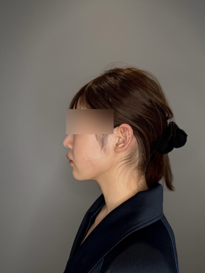 ベイザー脂肪吸引(術後6ヶ月経過:26)の術後写真