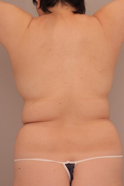 上半身の脂肪吸引 劇的な変化です。