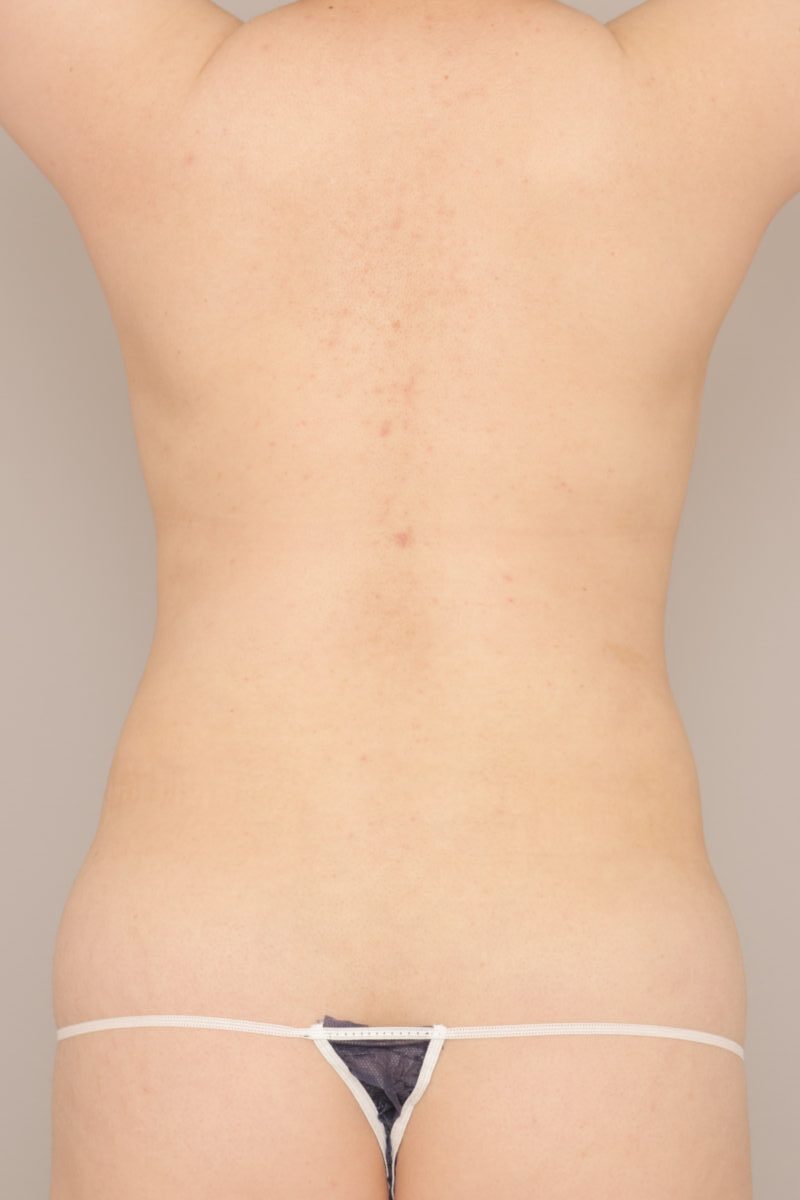 腰と背中の脂肪吸引がどれだけ効果的かお見せいたします。