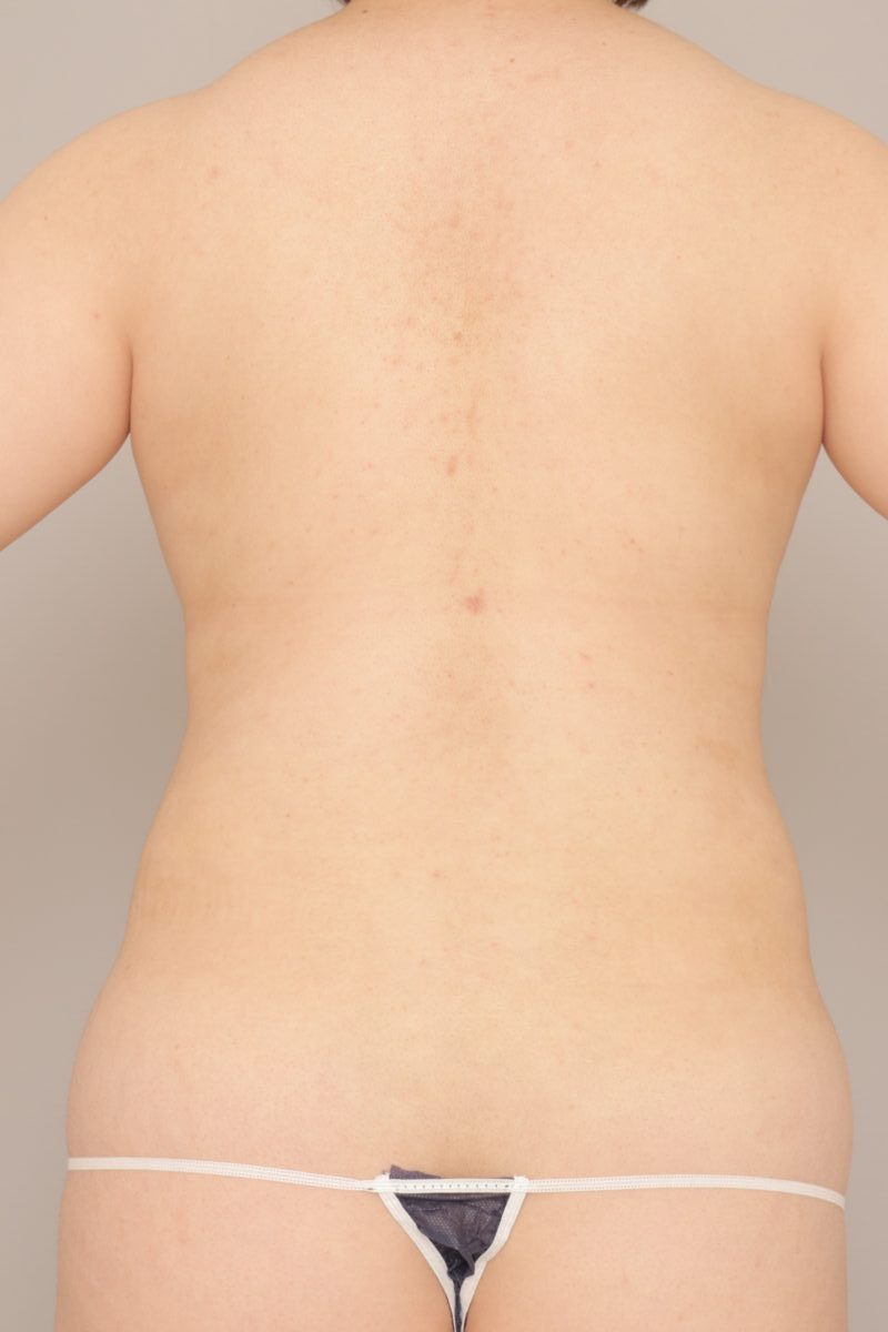 ベイザー脂肪吸引（１か月経過：28）の術後写真