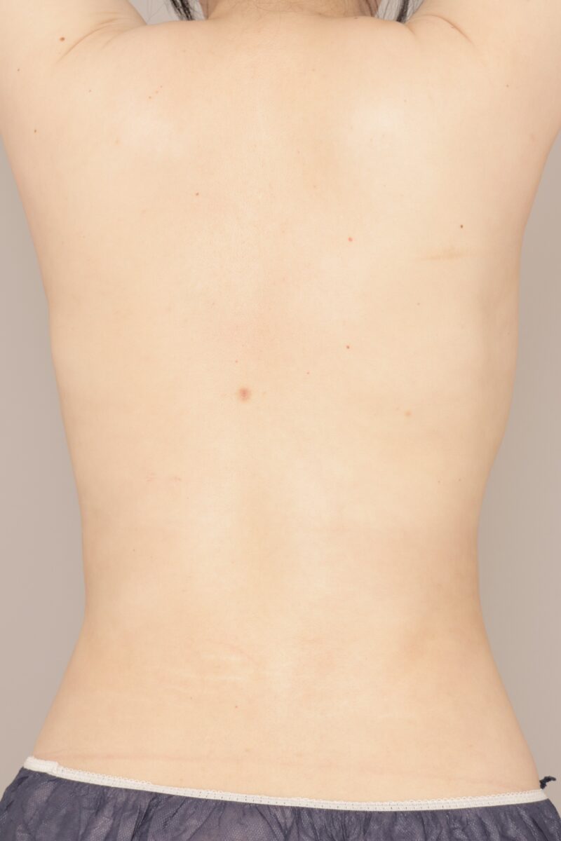 肩甲骨上下の1か月経過のご紹介です。