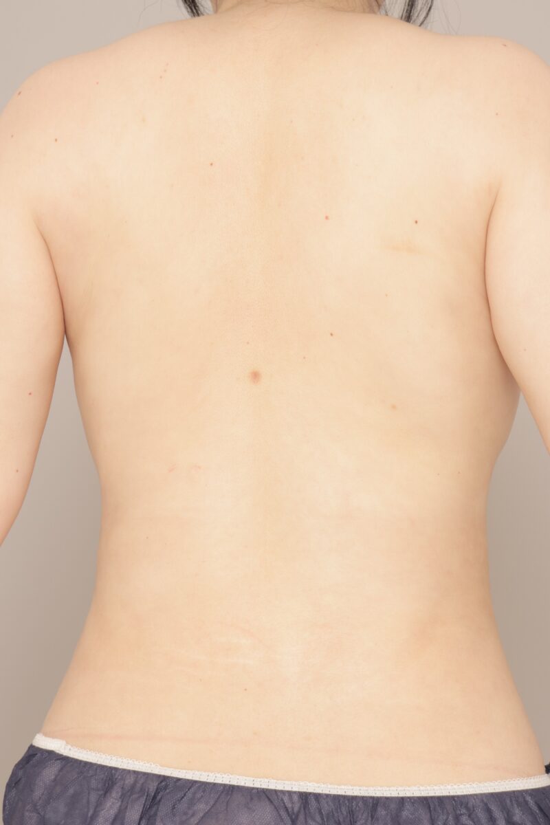 ベイザー脂肪吸引（１か月経過：38）の術後写真