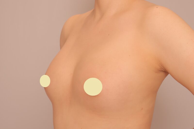 ベイザー脂肪吸引（１ヶ月経過：31）の術後写真