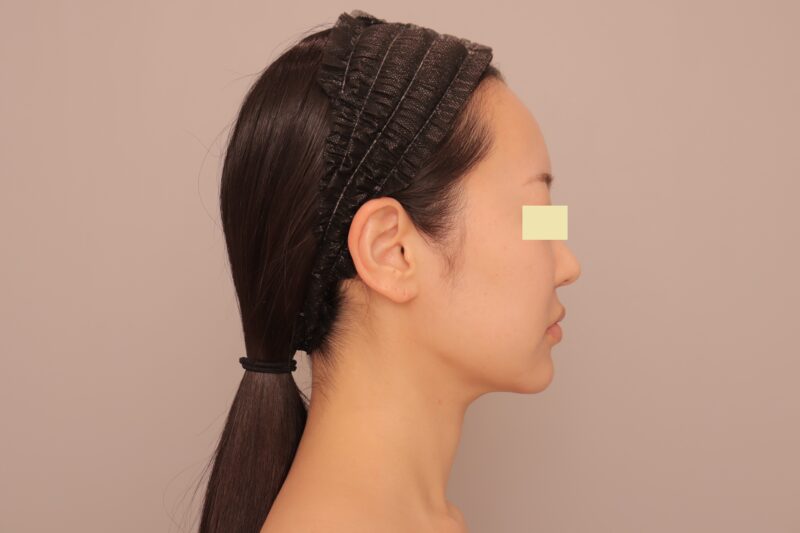 ベイザー脂肪吸引(半年経過:35)の術後写真