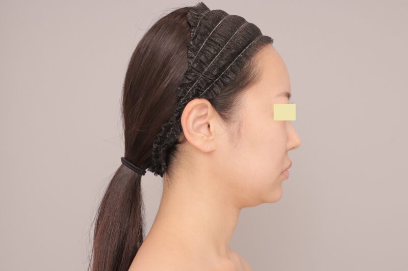 ベイザー脂肪吸引(半年経過:35)の術前写真