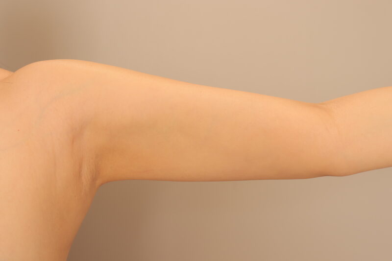 ベイザー脂肪吸引(半年経過:39)の術後写真