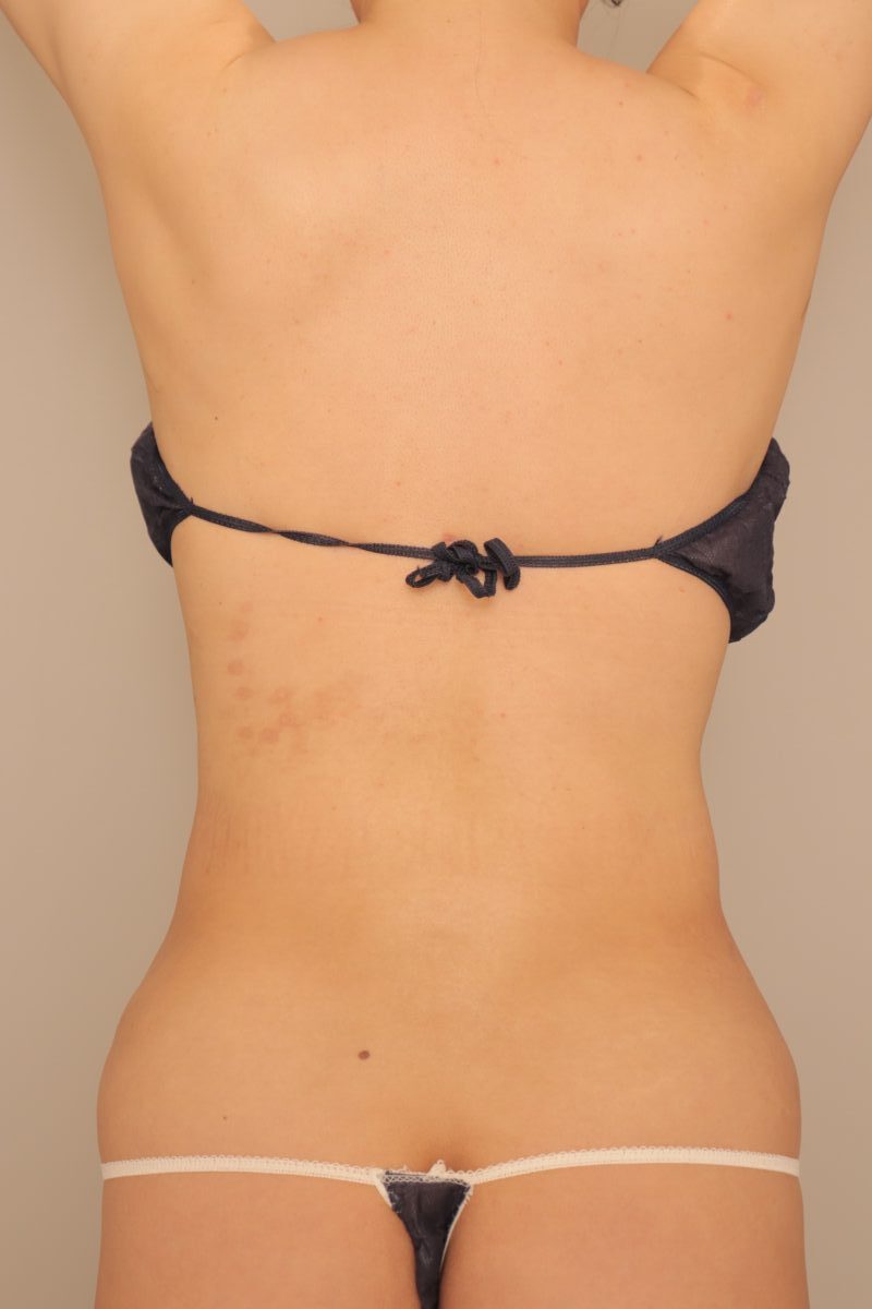 ベイザー脂肪吸引（半年経過：39）の術後写真