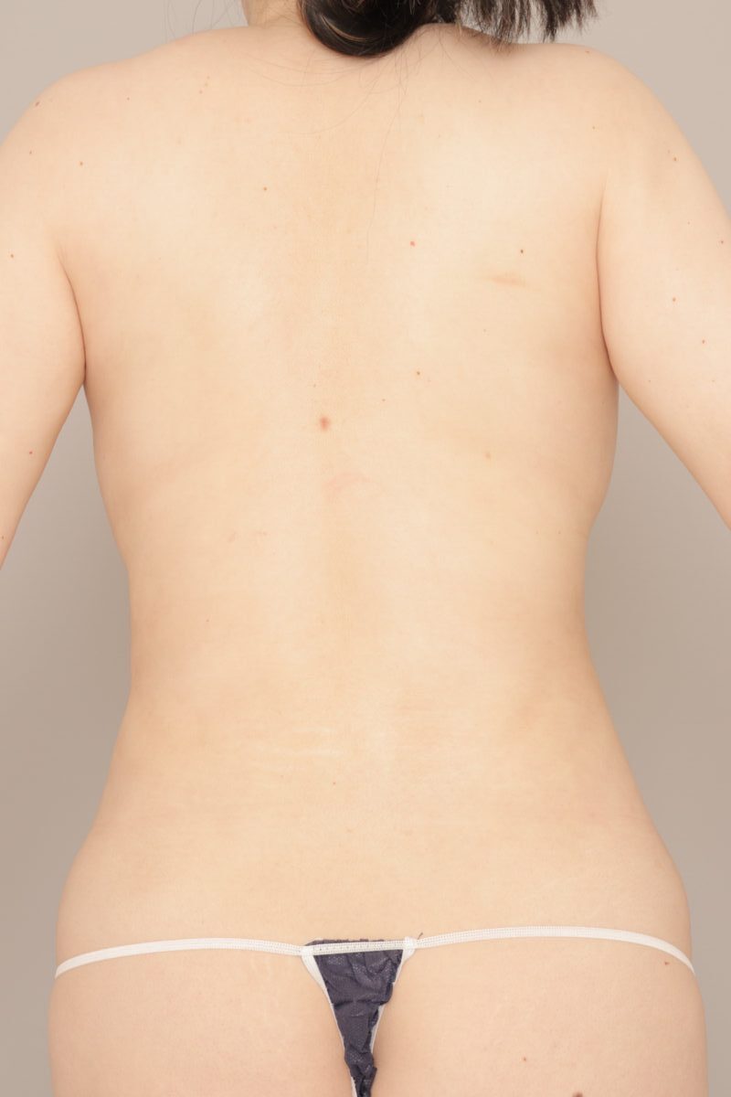 ベイザー脂肪吸引(3か月経過:38)の術後写真