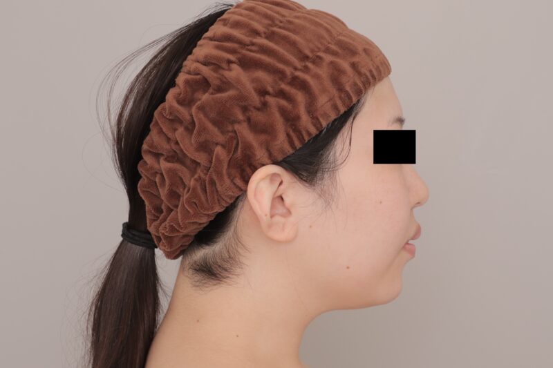 ベイザー脂肪吸引（3ヶ月経過：27）の術前写真