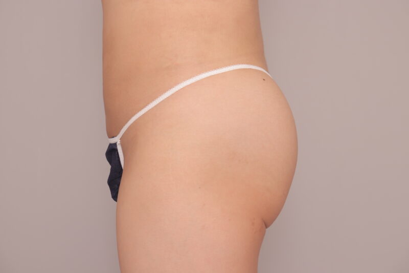 ベイザー脂肪吸引(1ヶ月経過:36)の術後写真