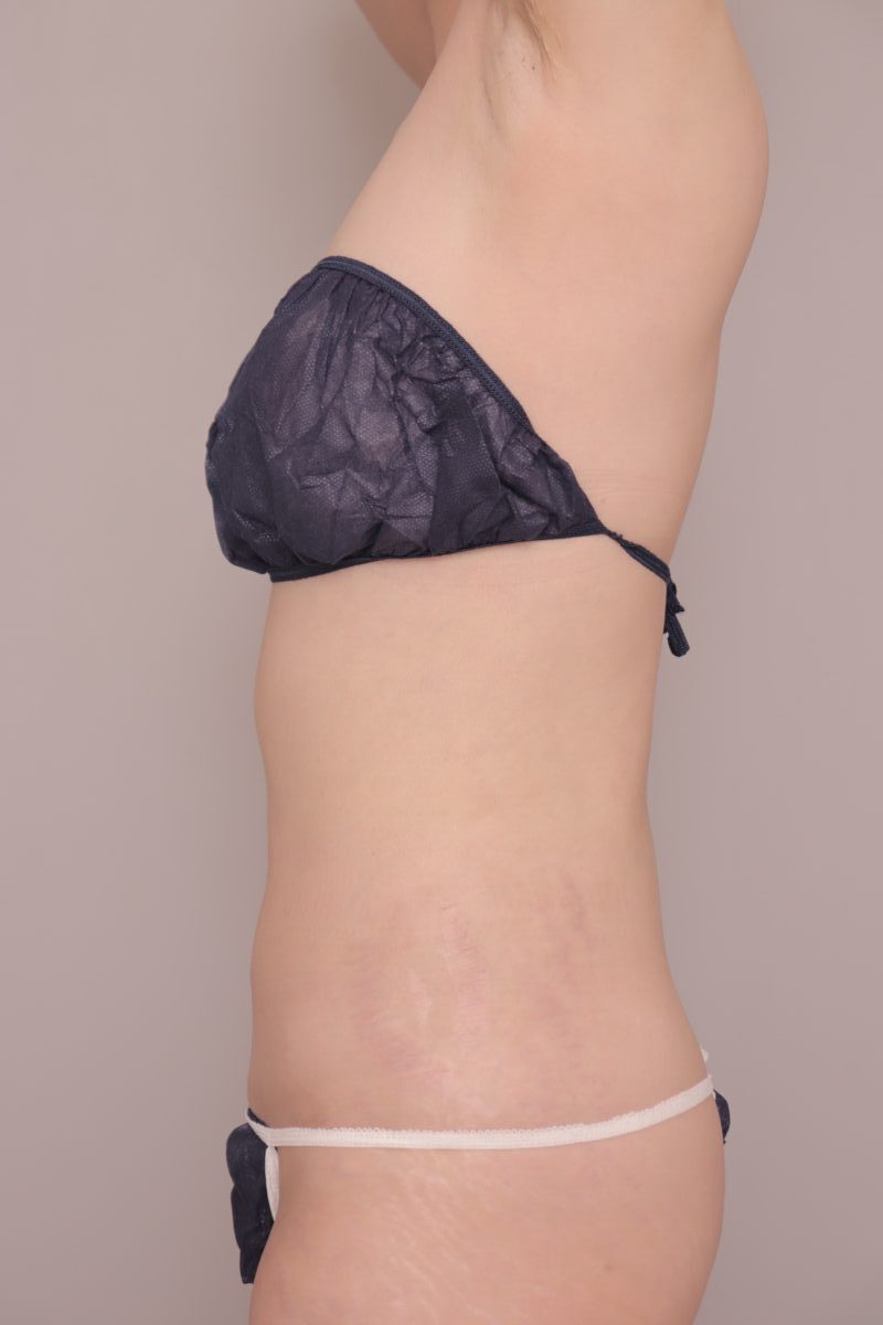 ★脂肪吸引のみでここまで引き締まりました！