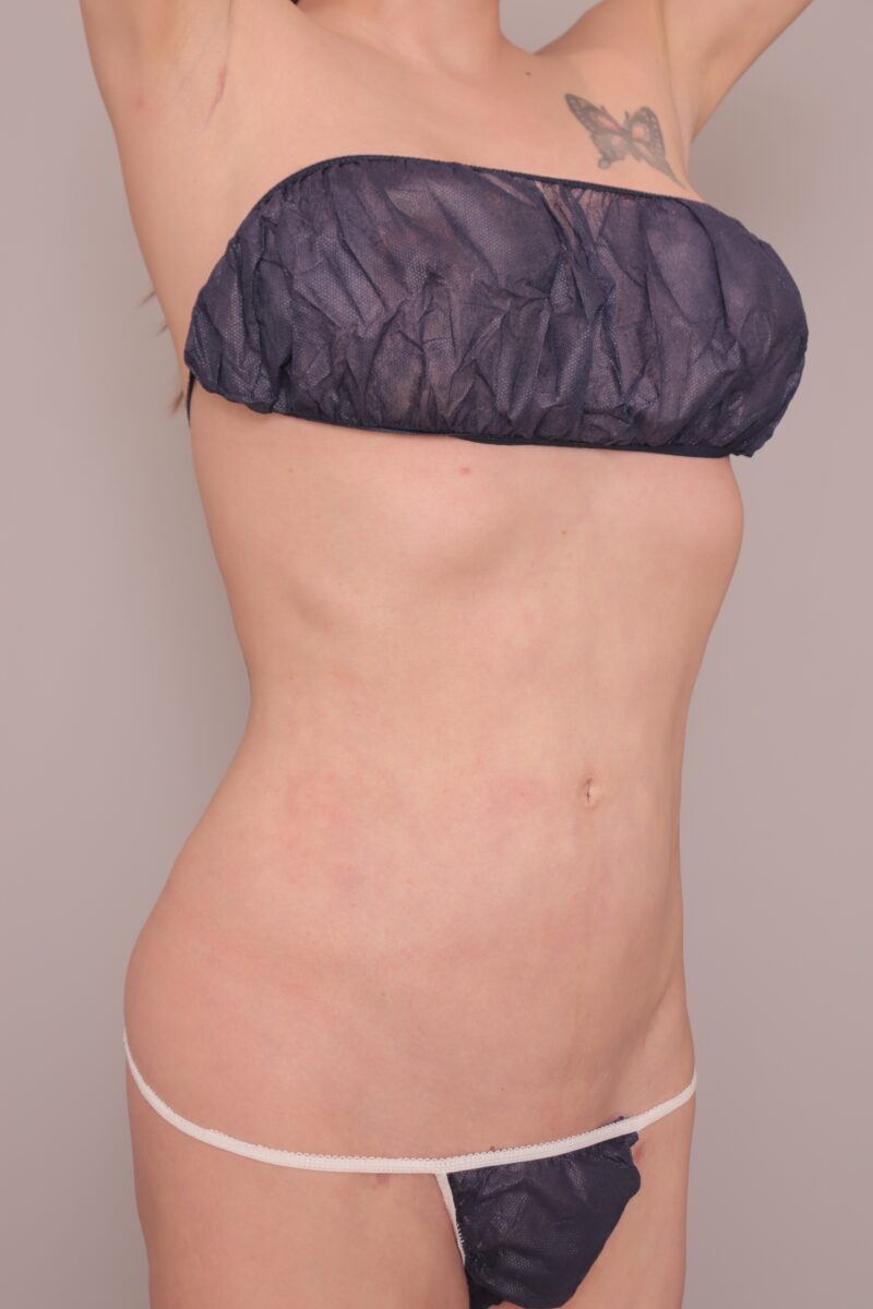 ベイザー脂肪吸引（半年後経過：36）の術後写真