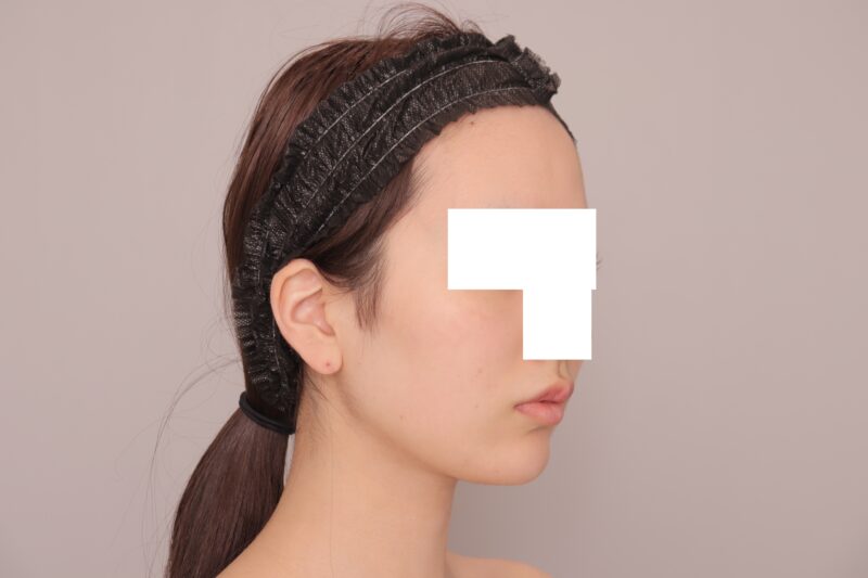 ベイザー脂肪吸引(半年経過:19)の術後写真