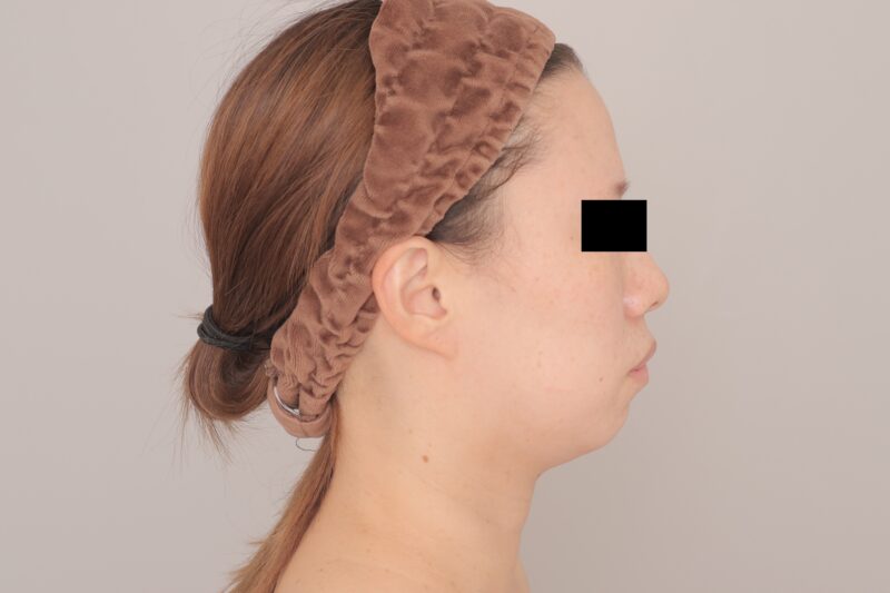 ベイザー脂肪吸引（6ヶ月経過：33）の術前写真