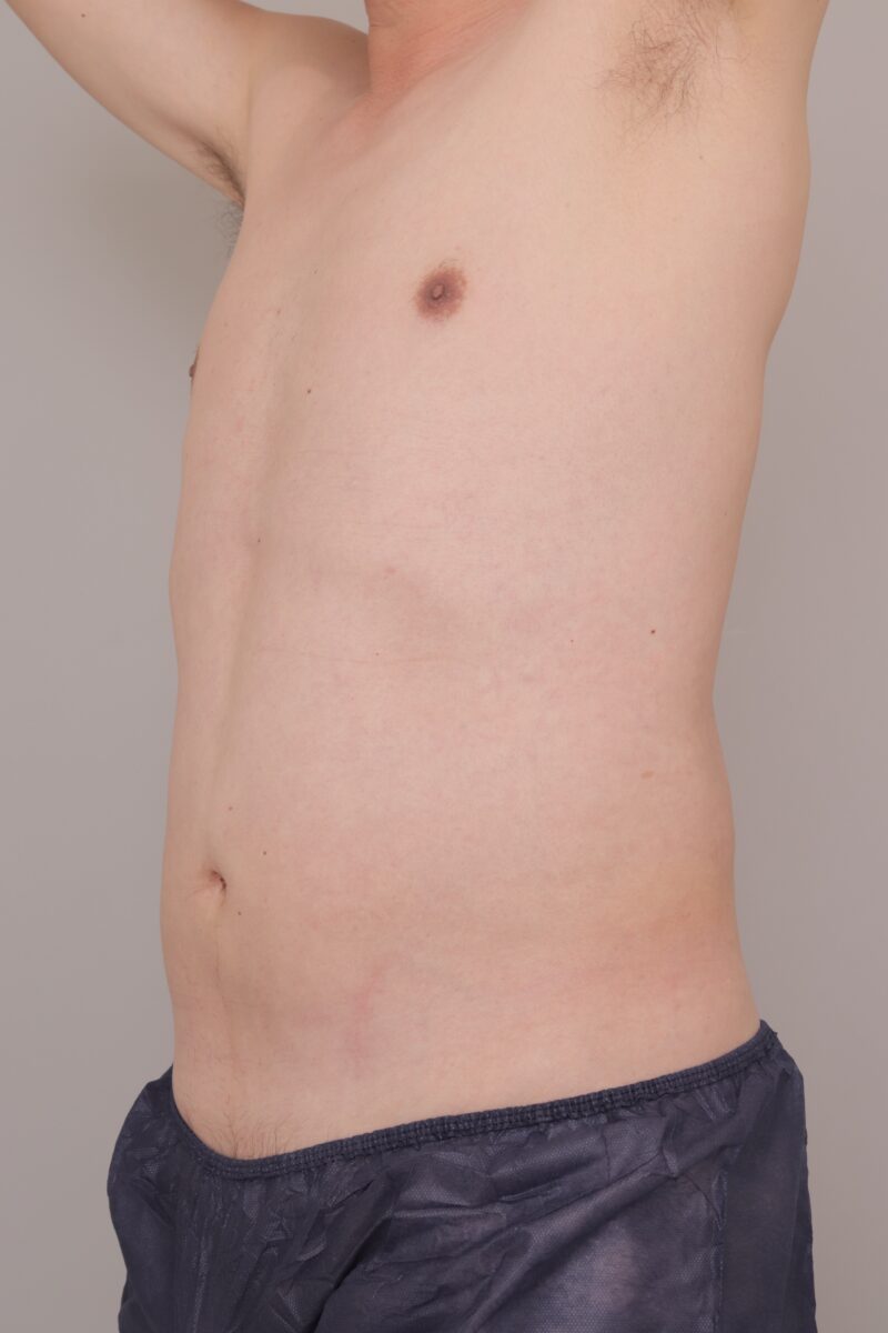 男性の腹腰吸引おすすめ！3ヶ月