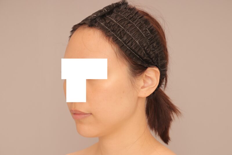 ベイザー脂肪吸引(半年経過:36)の術前写真