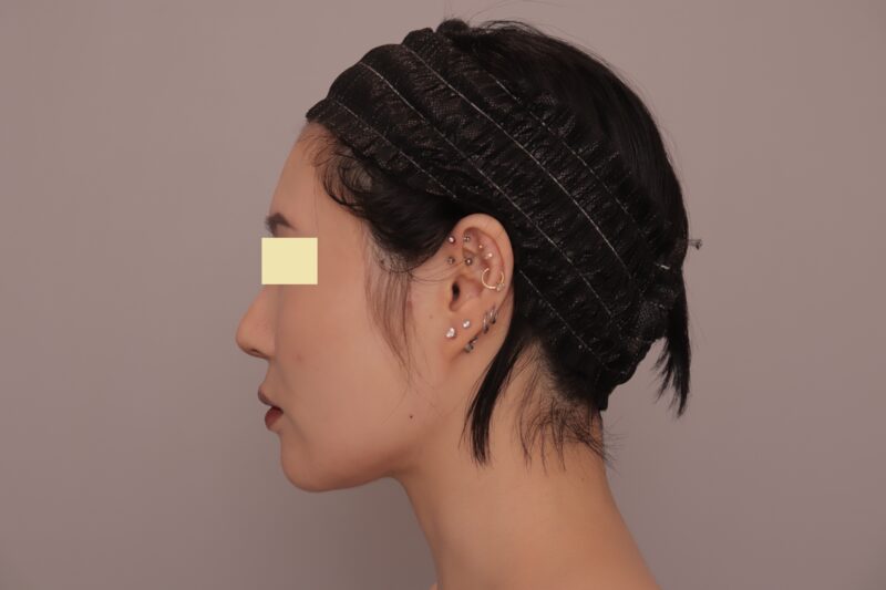 ★フェイスライン激変